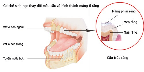 Hệ răng miệng rất dễ tôn thương, mảng bám hình thành khi chúng ta không chăm sóc đúng cách